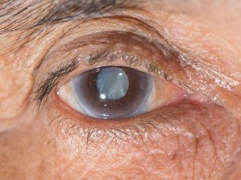 5 vấn đề về bệnh cườm đá trong mắt nhất định không được bỏ qua