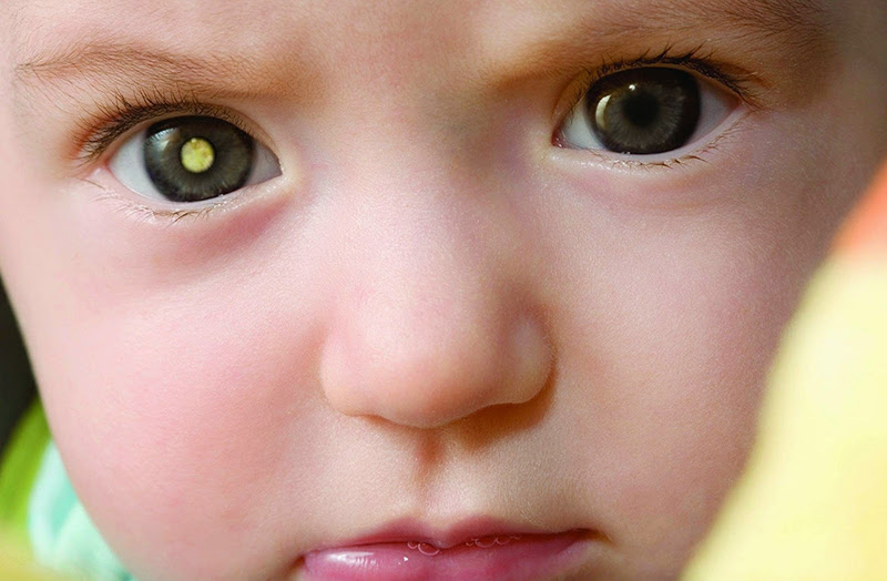 Trẻ em có thể bị đục thủy tinh thể do gen từ gia đình