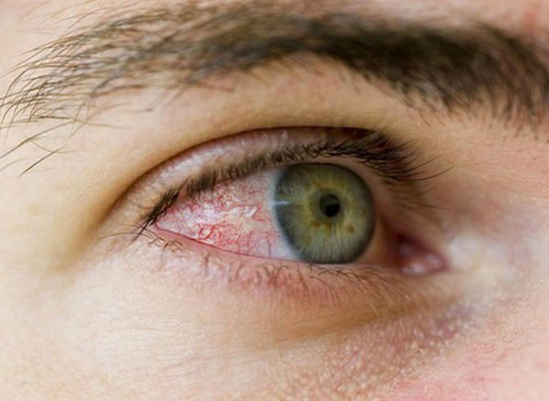 Nhiễm trùng mắt là một biến chứng sau mổ đục thủy tinh thể
