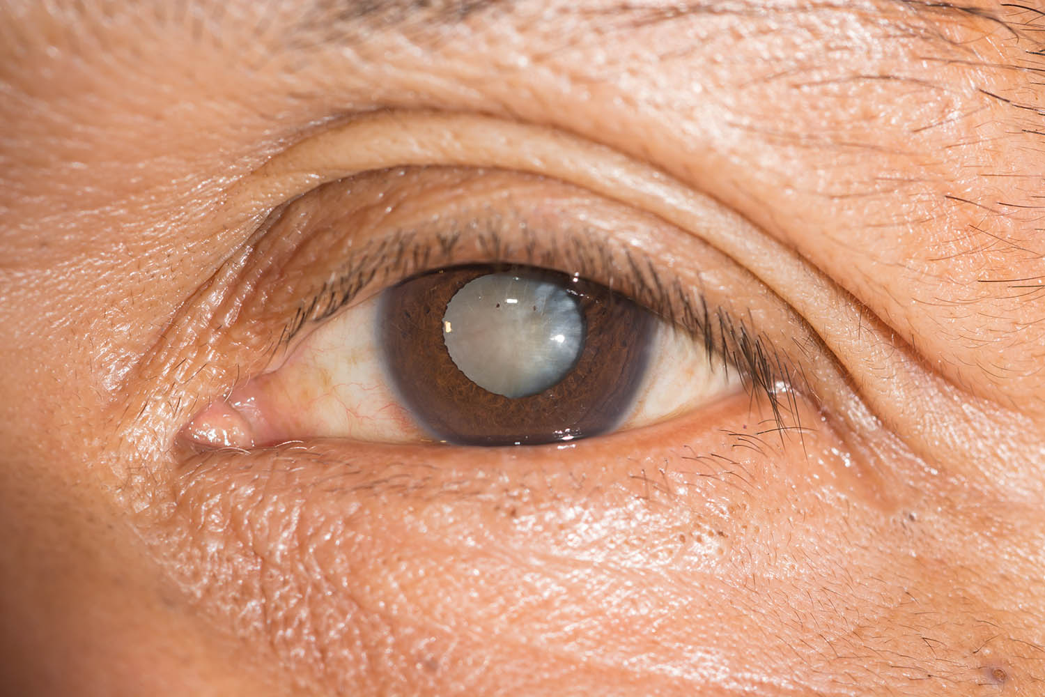 Mắt đục thủy tinh thể có nguy hiểm không? Bệnh sẽ làm giảm thị lực và lâu dẫn dẫn tới mù lòa