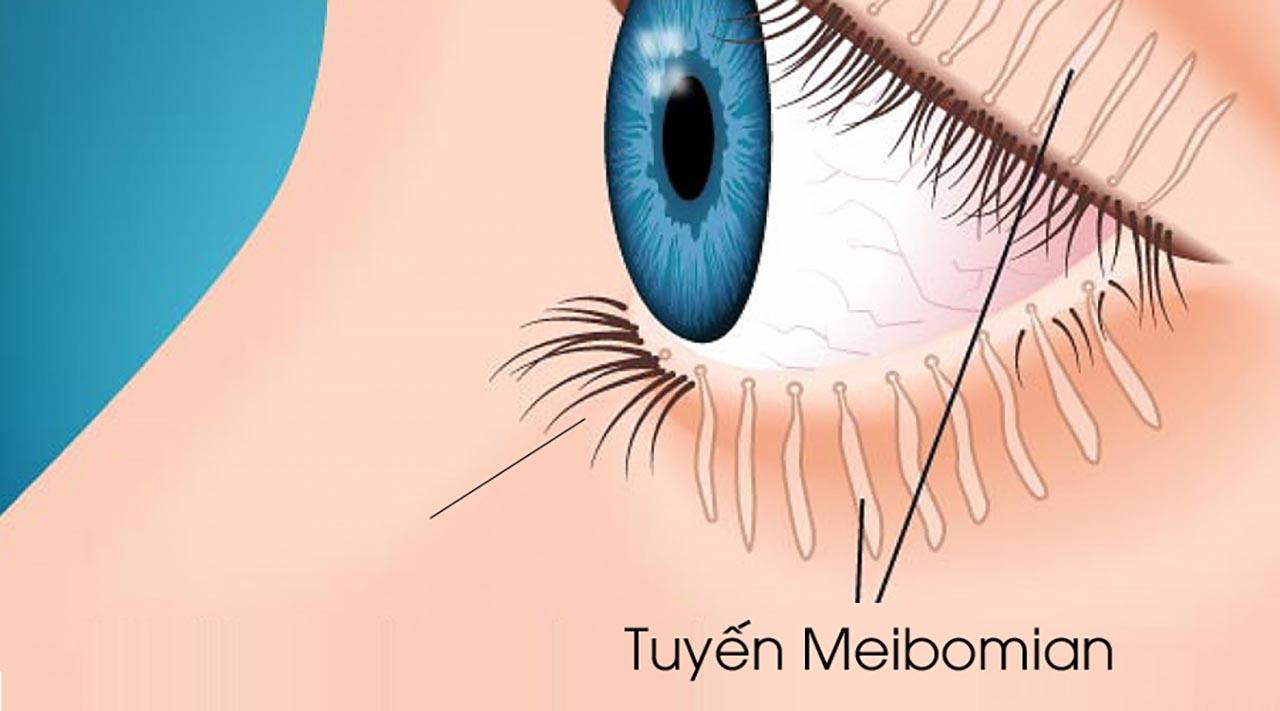MGD là gì trong bệnh khoé mắt?
