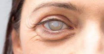 CATARACT: CAUSES AND DIAGNOSIS
