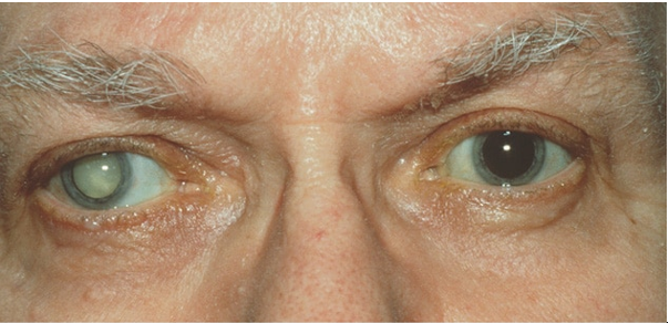 CATARACT TREATMENT