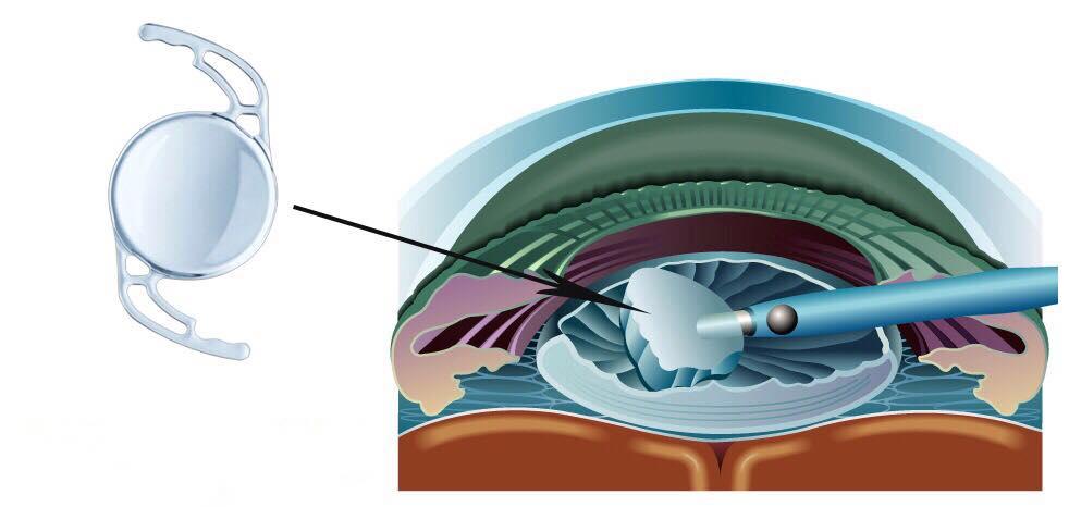 CATARACT TREATMENT USING INTRAOCULAR LENS (PHACOEMULSIFICATION)