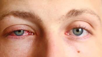 Mắt bị cườm là gì? Nguyên nhân và phương pháp điều trị 