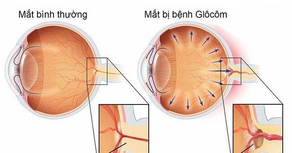 TRIỆU CHỨNG VÀ CÁCH ĐIỀU TRỊ GLÔCÔM