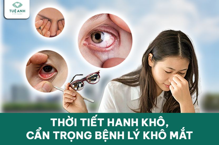 Thời tiết hanh khô, cẩn trọng bệnh lý khô mắt