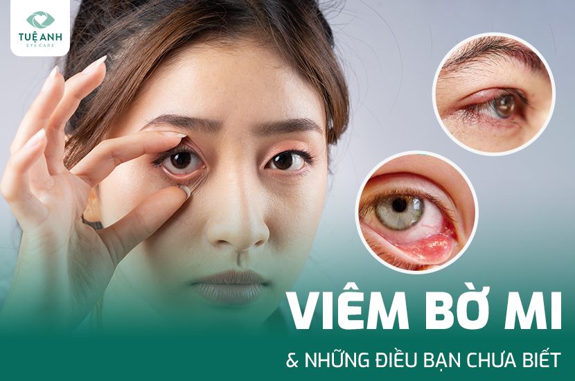 Viêm bờ mi và những điều cần biết