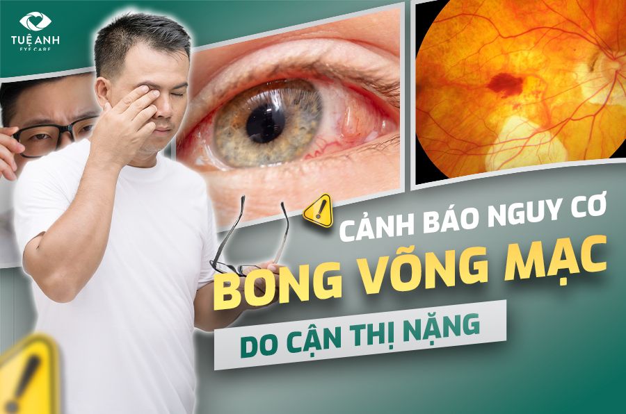 Cảnh báo nguy cơ bong võng mạc do cận thị nặng