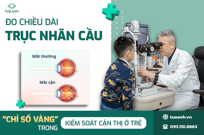 Chiều Dài Trục Nhãn Cầu – “Chỉ Số Vàng” Trong Kiểm Soát Cận Thị Ở Trẻ
