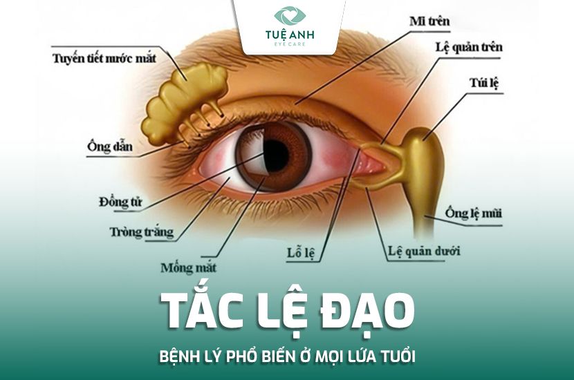 Tắc Lệ Đạo – Bệnh Lý Âm Thầm Ở Mọi Lứa Tuổi