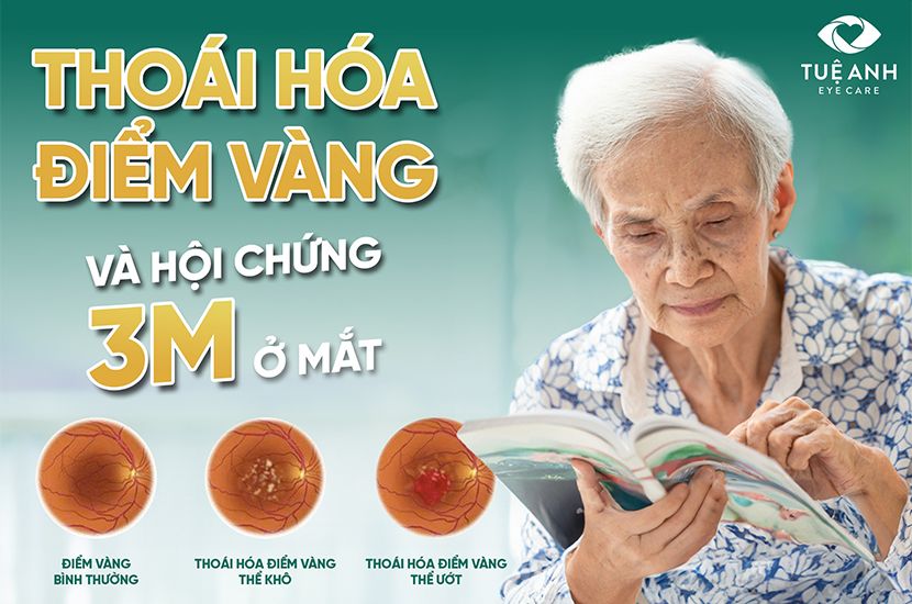 Thoái hóa điểm vàng tuổi già & Hội chứng 3M ở mắt