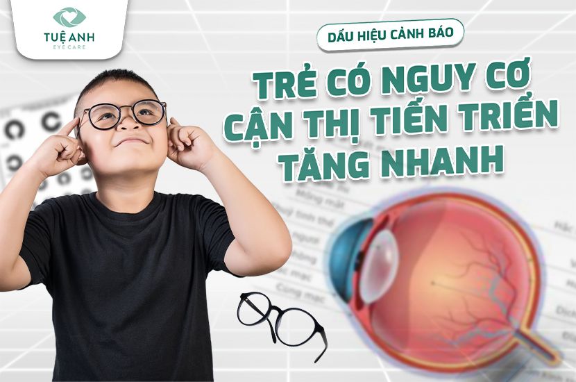 Dấu hiệu cảnh báo trẻ có nguy cơ cận thị tiến triển nhanh