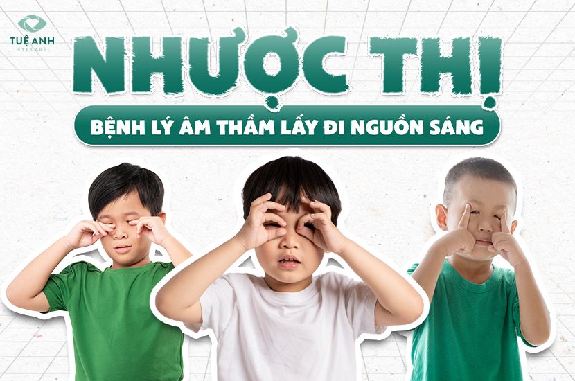 Nhược thị ở trẻ – Mắt yếu âm thầm, cần phát hiện sớm để không mất thị lực vĩnh viễn