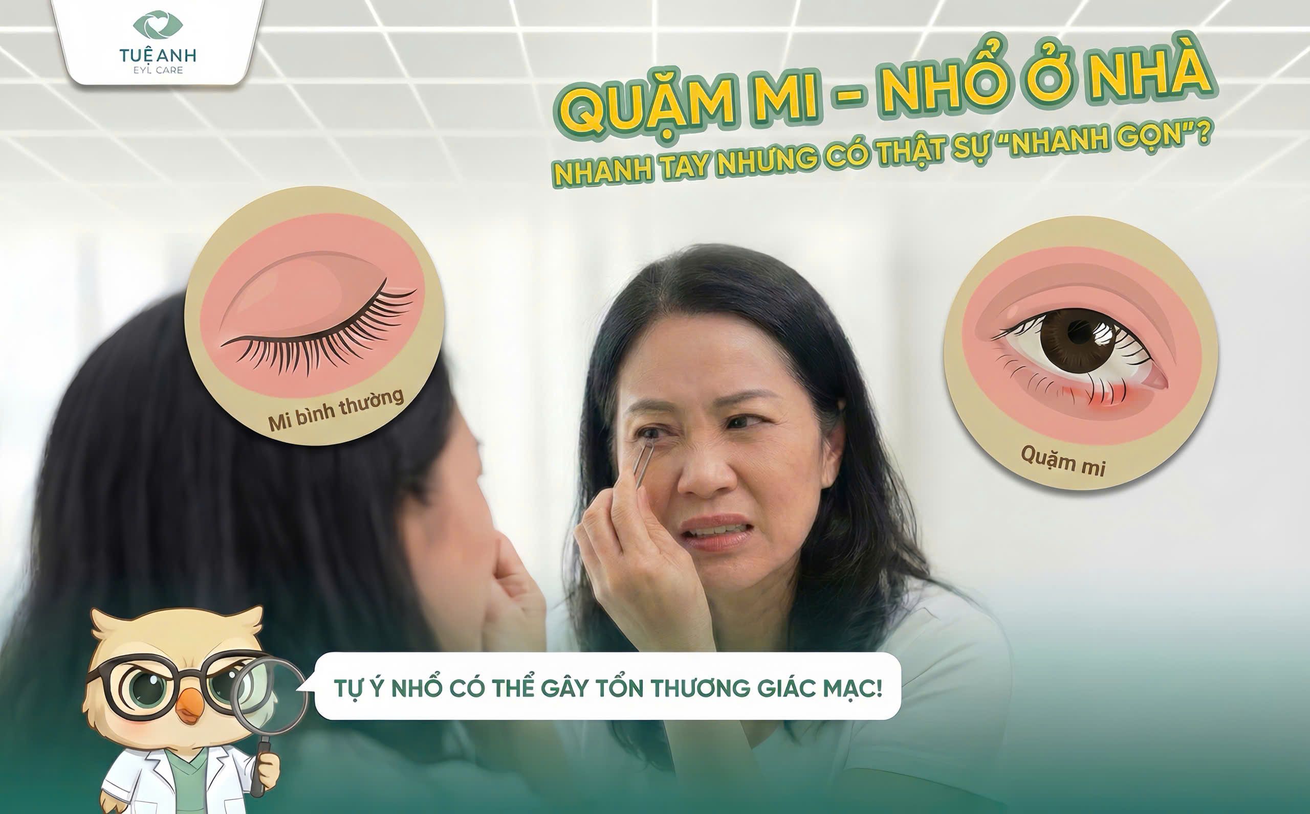 Quặm mi - Nhổ ở nhà: Nhanh tay nhưng có thật sự 