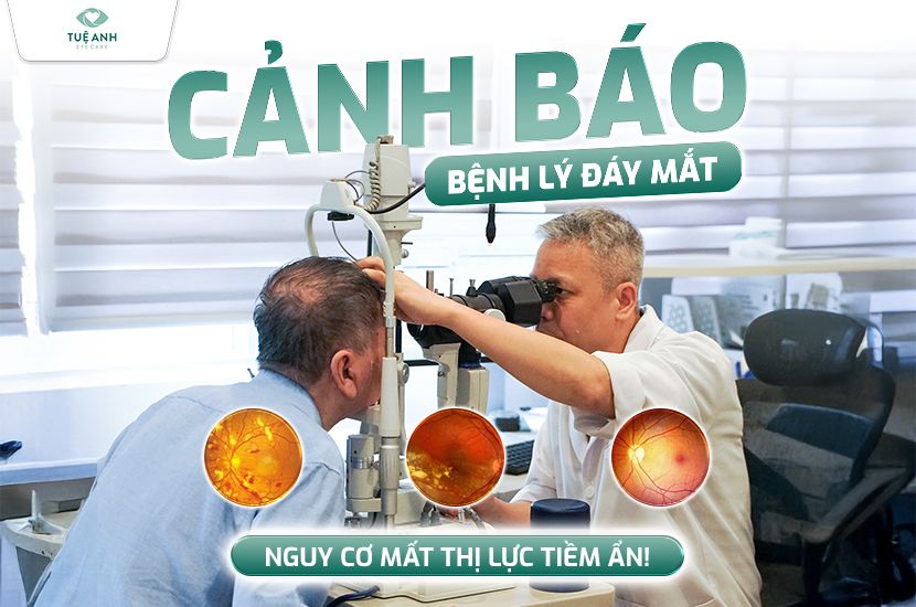 Cảnh báo các bệnh lý đáy mắt: Nguy cơ mất thị lực tiềm ẩn 