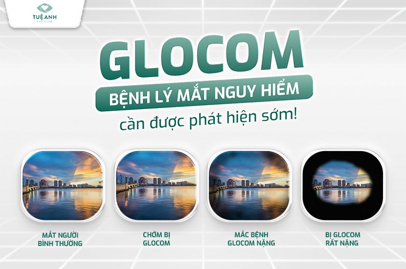 Bệnh glocom là gì? Cảnh báo bệnh lý nguy hiểm cần tầm soát sớm 