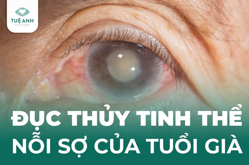 ĐỤC THỦY TINH THỂ - NỖI SỢ CỦA TUỔI GIÀ