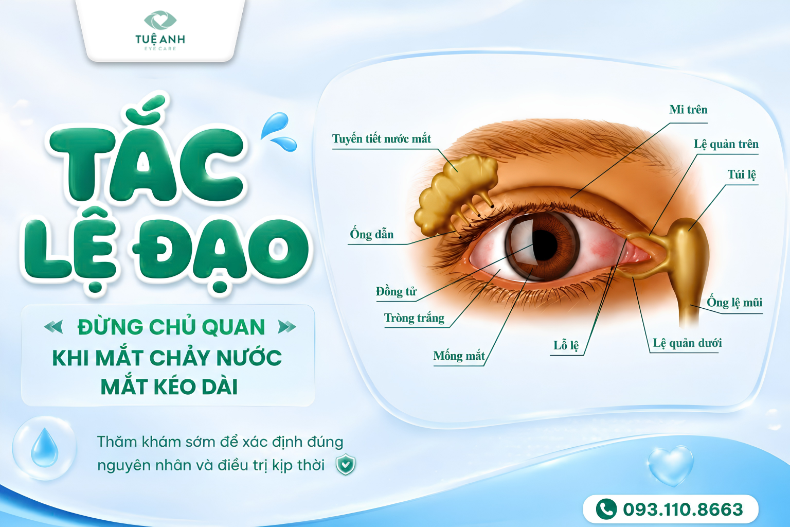 Tắc lệ đạo: Nguyên nhân gây chảy nước mắt sống và cách điều trị 