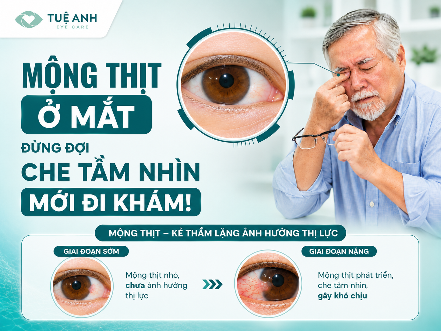Mông thị ở mắt: Nguyên nhân và cách phòng tránh
