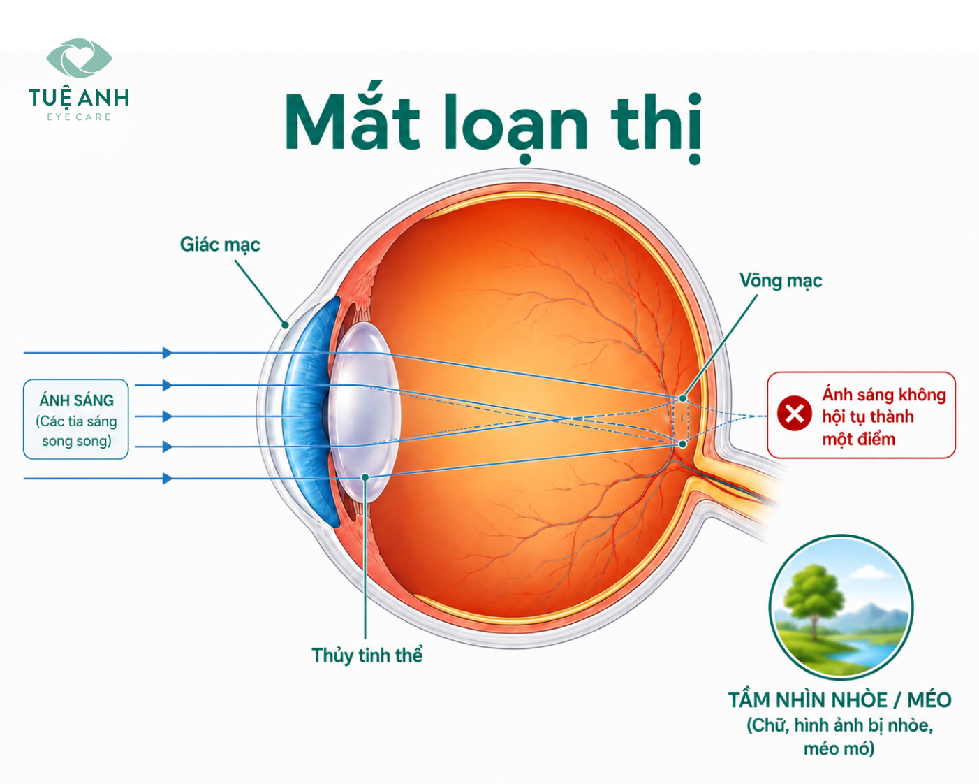 Loạn thị là gì? Nguyên nhân, dấu hiệu và cách điều chỉnh