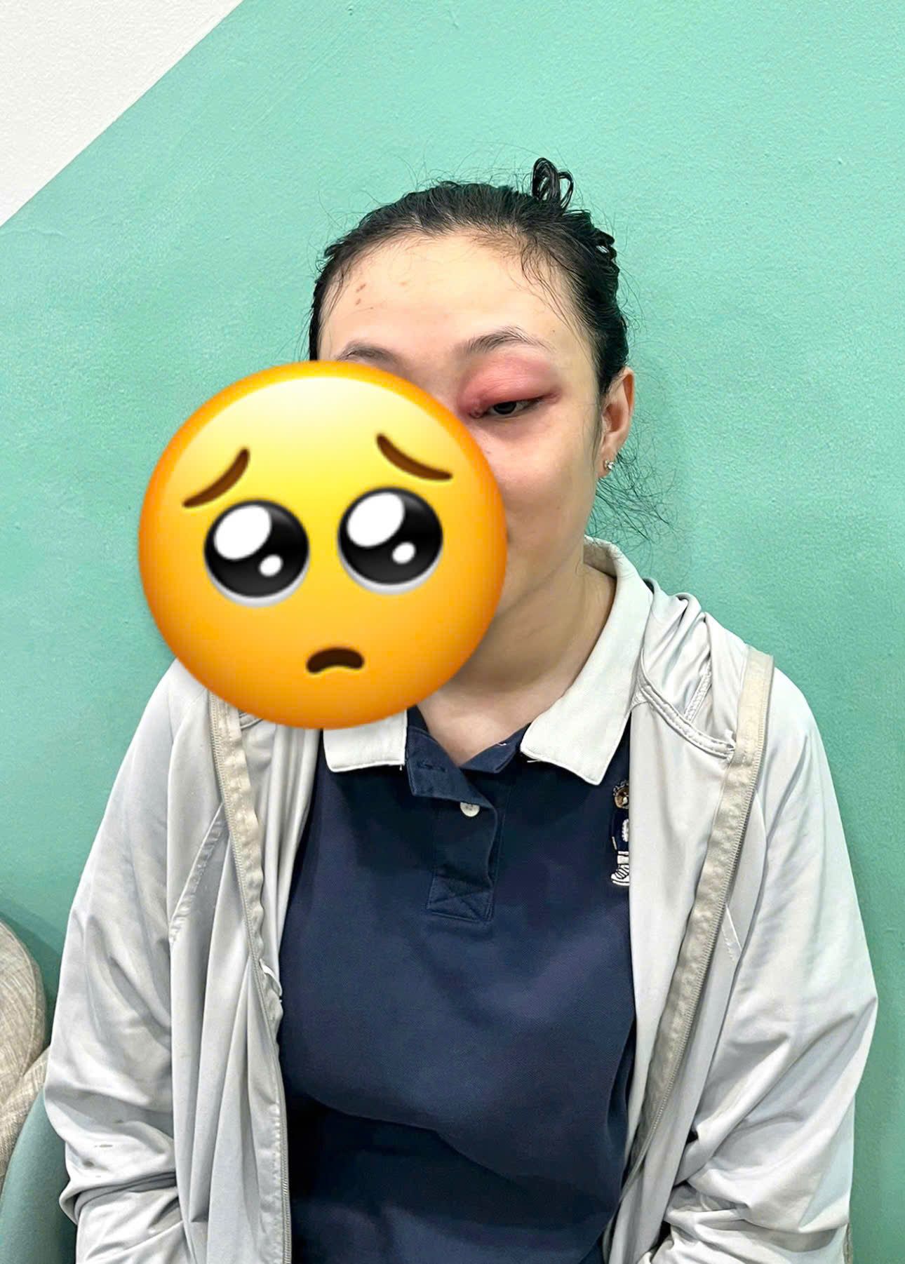 Từ một nốt mụn sưng nhỏ ở đầu mắt, 2 ngày sau sưng tấy, vỡ mủ trong đêm - Cảnh báo hậu quả khi nhỏ thuốc không đúng bệnh