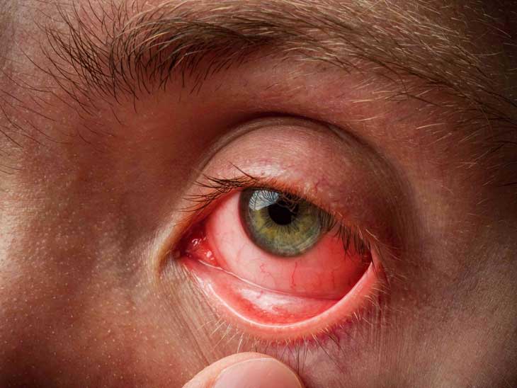 Đỏ mắt là một triệu chứng của dạng cườm nước góc đóng