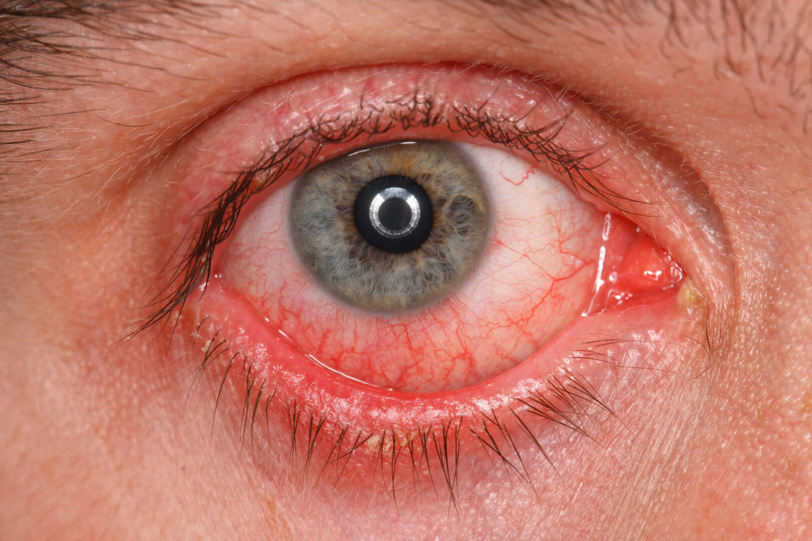 Glocom góc đóng là trường hợp bị tắc nghẽn góc tiền phòng do mống mắt ngoại vi áp lên vùng bè
