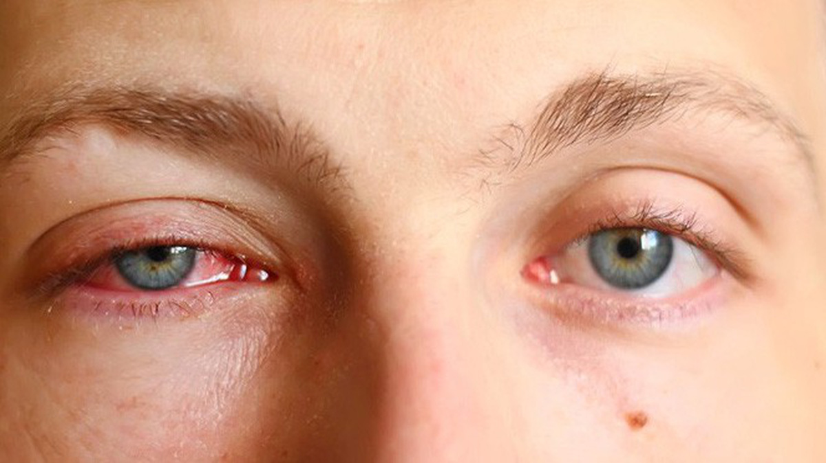 Đau mắt, sưng mắt, đỏ mắt là dấu hiệu của mắt bị cườm nước