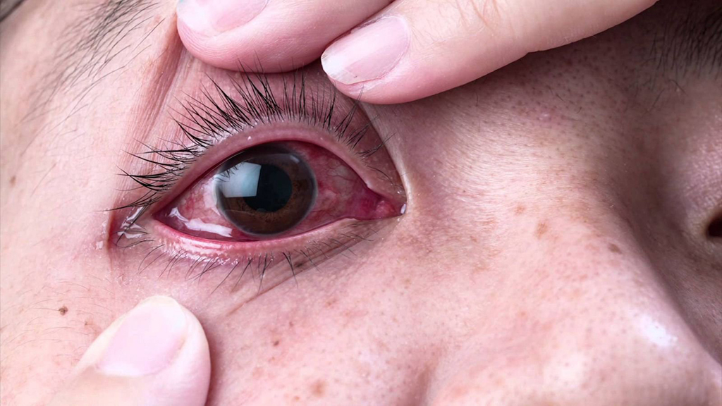 Các triệu chứng ở mắt sẽ nặng dần theo thời gian