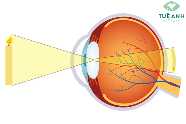 Hình ảnh của vật trên mắt viễn thị.